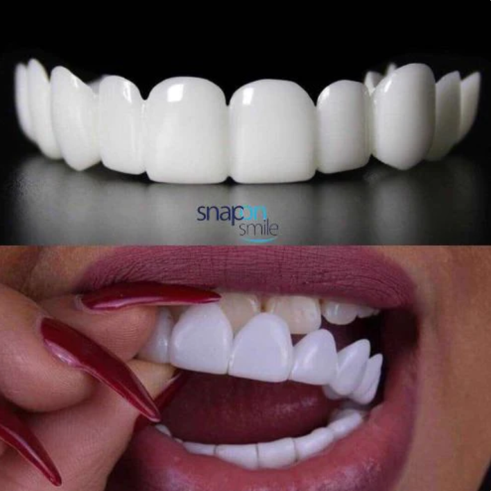 Diseño de Sonrisa INSTANTANEO de RESINA - Snap On Smile