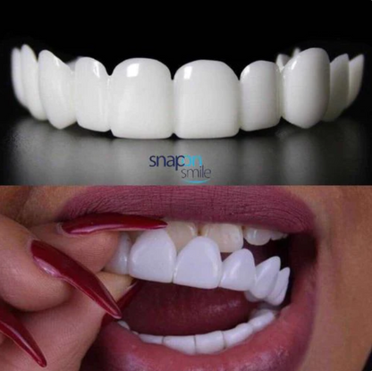 Diseño de Sonrisa INSTANTANEO de RESINA - Snap On Smile