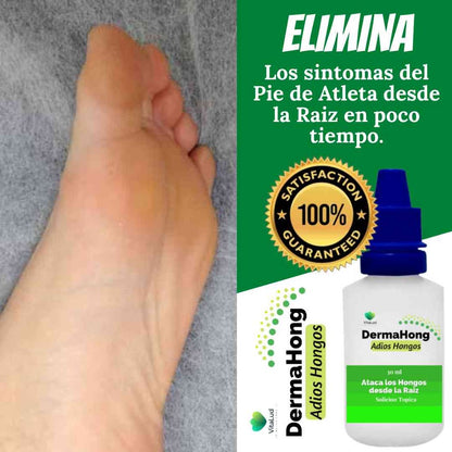 3X1 DERMAHONG - ADIOS HONGOS EN 15 DIAS ✅